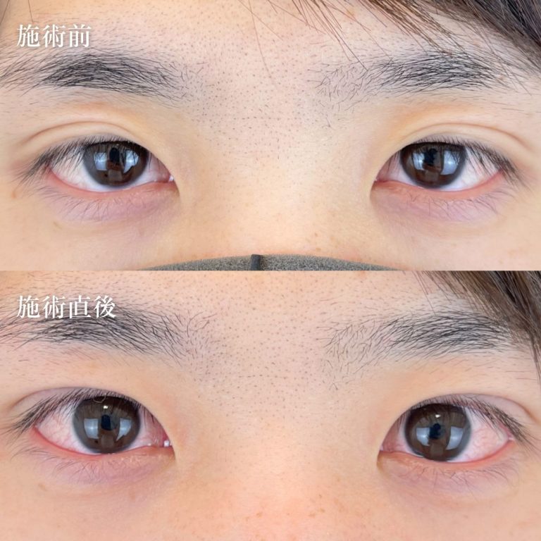 二重埋没法(担当医:TCB 医師)の症例写真1