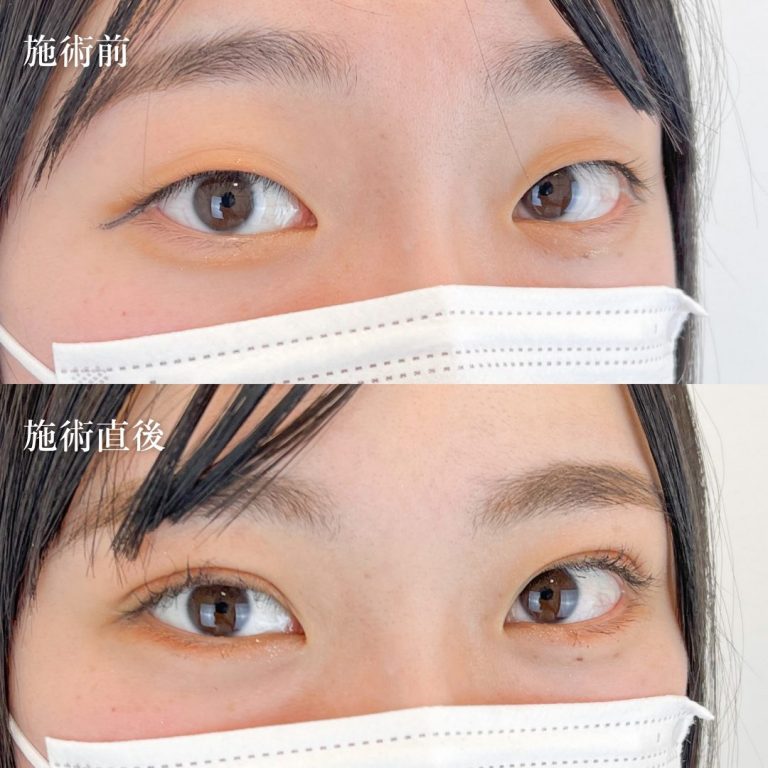 二重埋没法(担当医:TCB 医師)の症例写真1