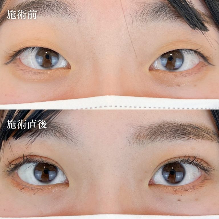 二重埋没法(担当医:TCB 医師)の症例写真2