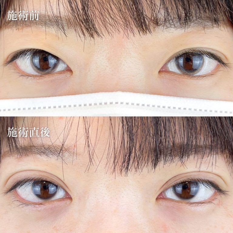 二重埋没法(担当医:TCB 医師)の症例写真1