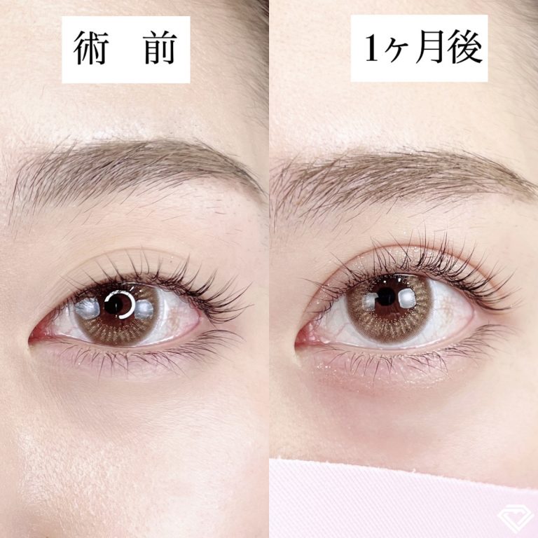 二重埋没法(担当医:TCB 医師)の症例写真1