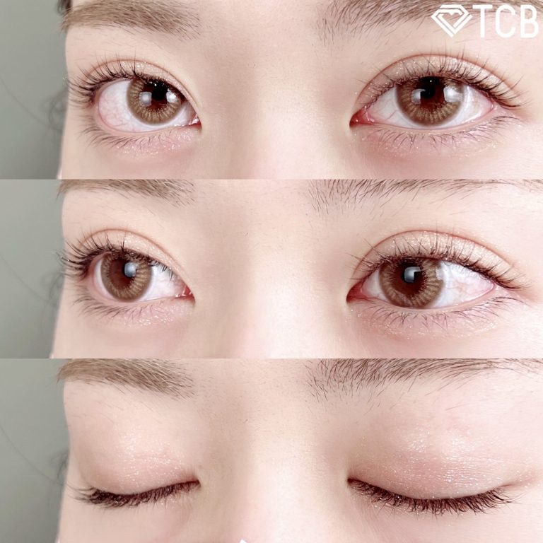 二重埋没法(担当医:TCB 医師)の症例写真2