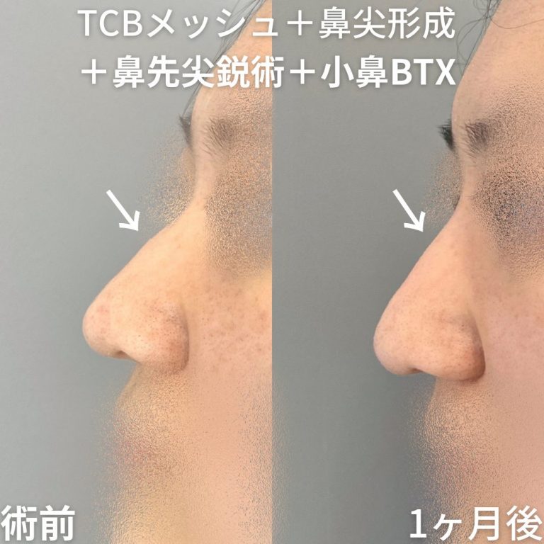 TCBメッシュ(担当医:山内 崇史 医師)の症例写真1