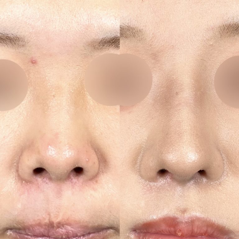 TCB式鼻先尖鋭術（だんご鼻解消）(担当医:今井 一臣 医師)の症例写真1