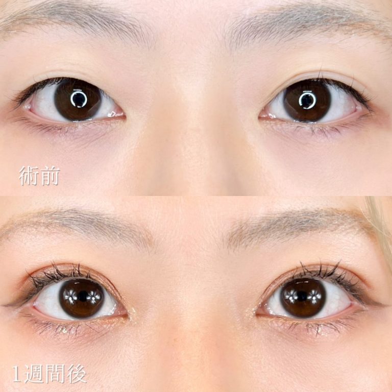 二重埋没法(担当医:TCB 医師)の症例写真1