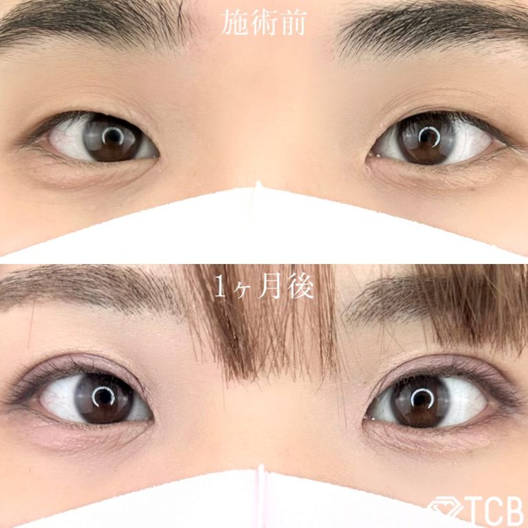 二重埋没法(担当医:TCB 医師)の症例写真1