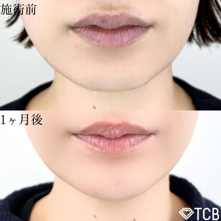 切らない顎形成 3D Eライン(担当医:TCB 医師)の症例写真1