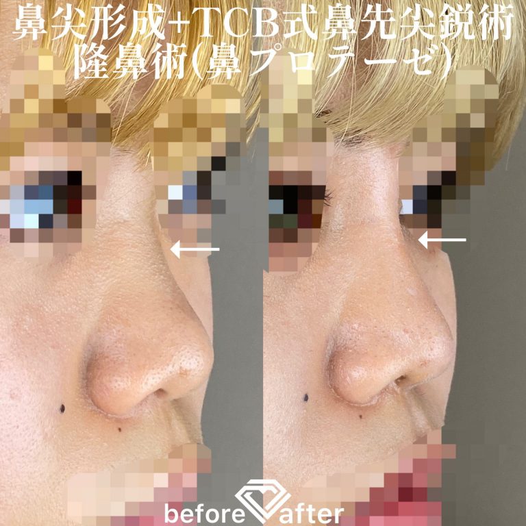 鼻尖形成(担当医:森本 理一郎 医師)の症例写真2