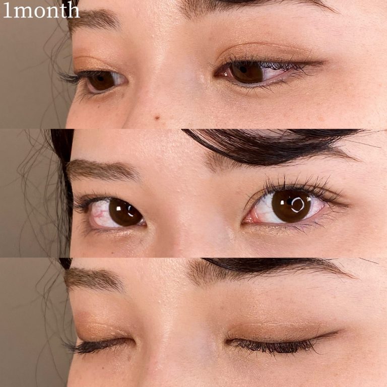 二重埋没法(担当医:TCB 医師)の症例写真3