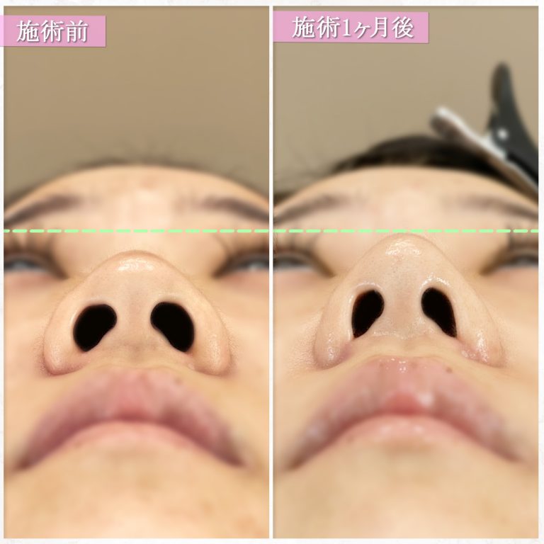 TCB式鼻翼縮小完全内側法(担当医:篠永 宏行 医師)の症例写真2