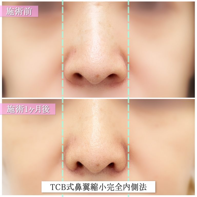 TCB式鼻翼縮小完全内側法(担当医:篠永 宏行 医師)の症例写真1