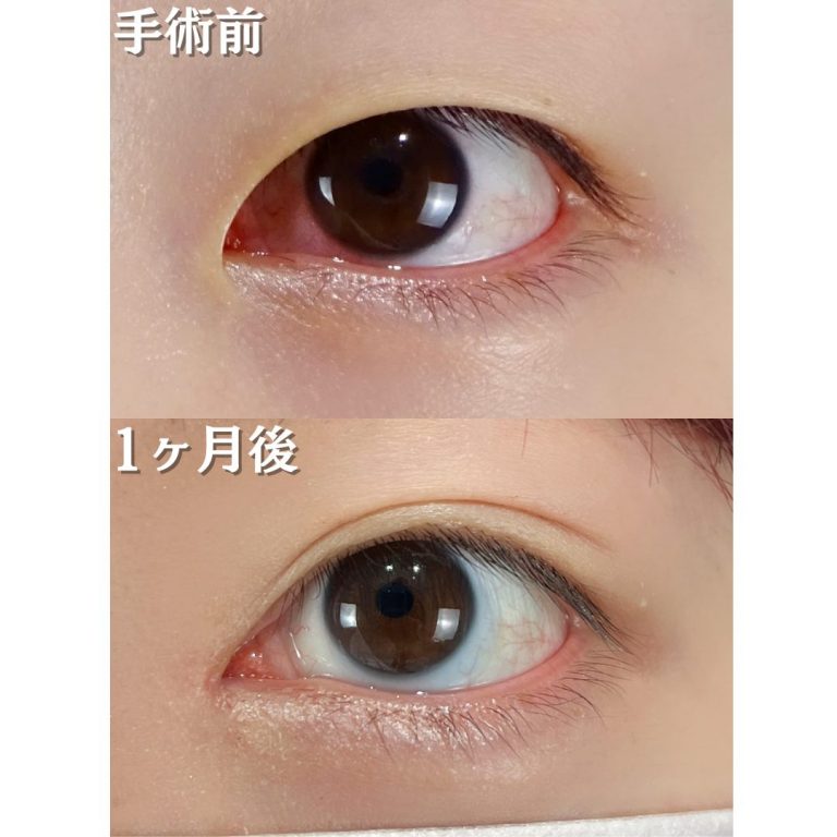 二重埋没法(担当医:TCB 医師)の症例写真1