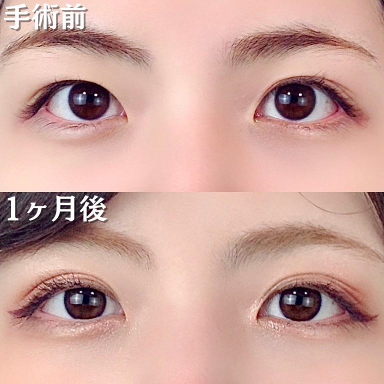 二重埋没法(担当医:TCB 医師)の症例写真1