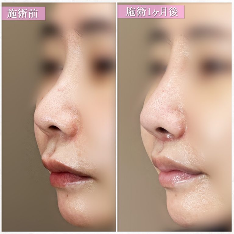 鼻プロテーゼ（隆鼻術）(担当医:篠永 宏行 医師)の症例写真2