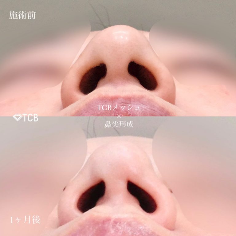鼻尖形成(担当医:佐藤 麻未 医師)の症例写真1