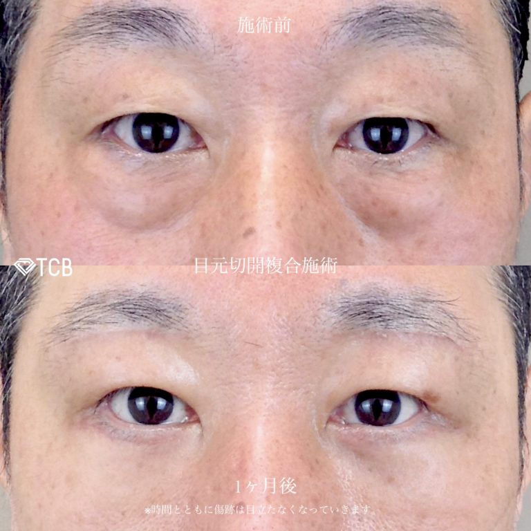 切開法による目の下のたるみ取り（下眼瞼除皺術）(担当医:佐藤 麻未 医師)の症例写真1