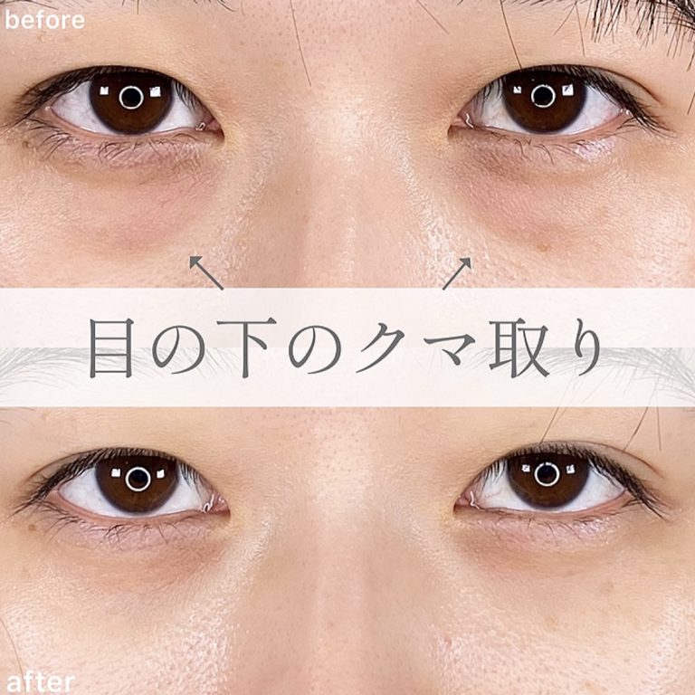 切らない目の下のクマ取り・目の下のたるみ（ふくらみ）取り(担当医:TCB 医師)の症例写真1