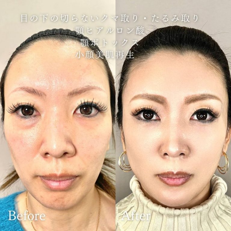 切らない目の下のクマ取り・目の下のたるみ（ふくらみ）取り(担当医:TCB 医師)の症例写真2