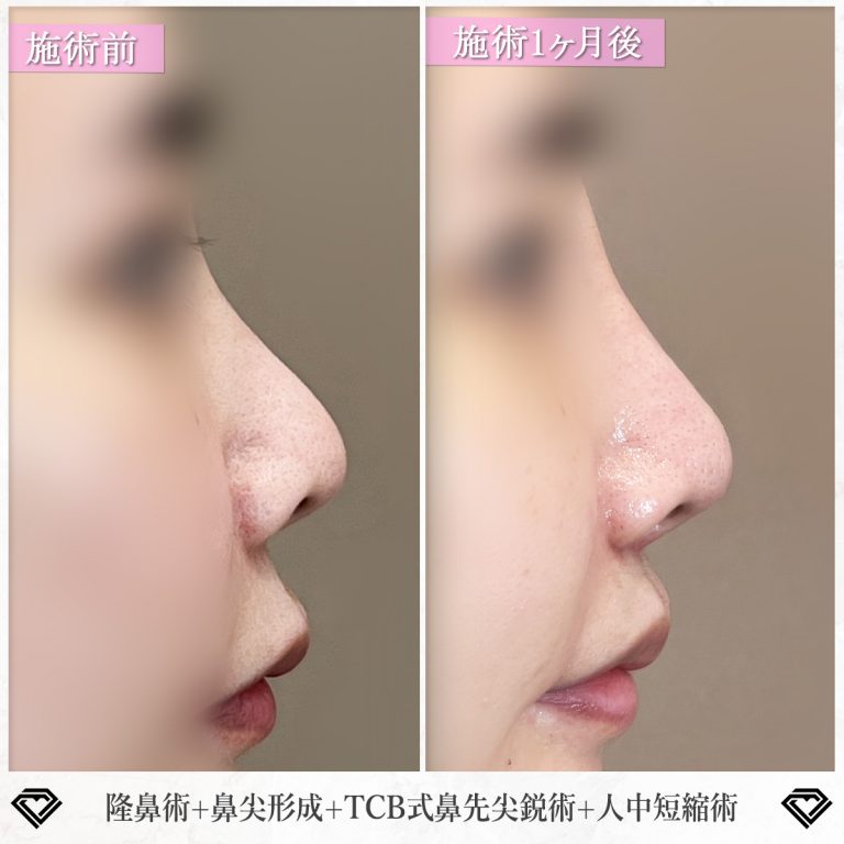 鼻プロテーゼ（隆鼻術）(担当医:篠永 宏行 医師)の症例写真1