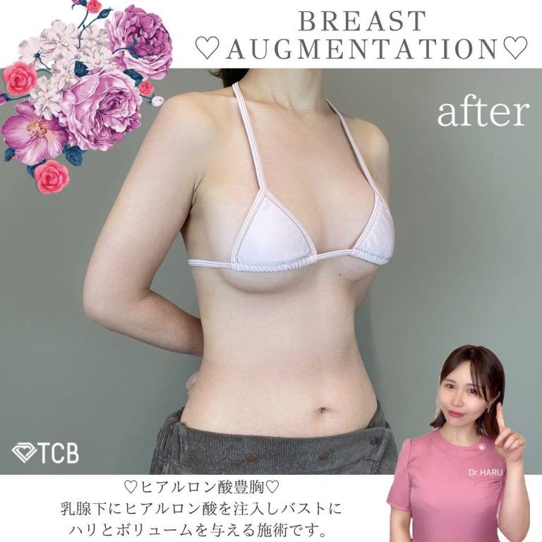 TCB式ヒアルロン酸豊胸(担当医:池田 悠 医師)の症例写真1
