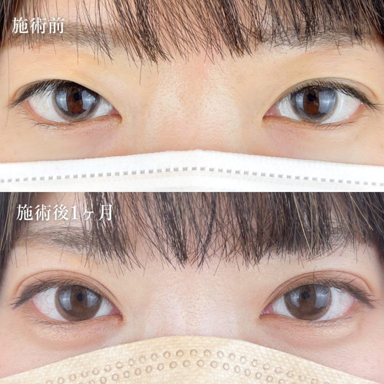 二重埋没法(担当医:TCB 医師)の症例写真1