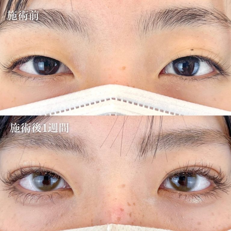 二重埋没法(担当医:TCB 医師)の症例写真1