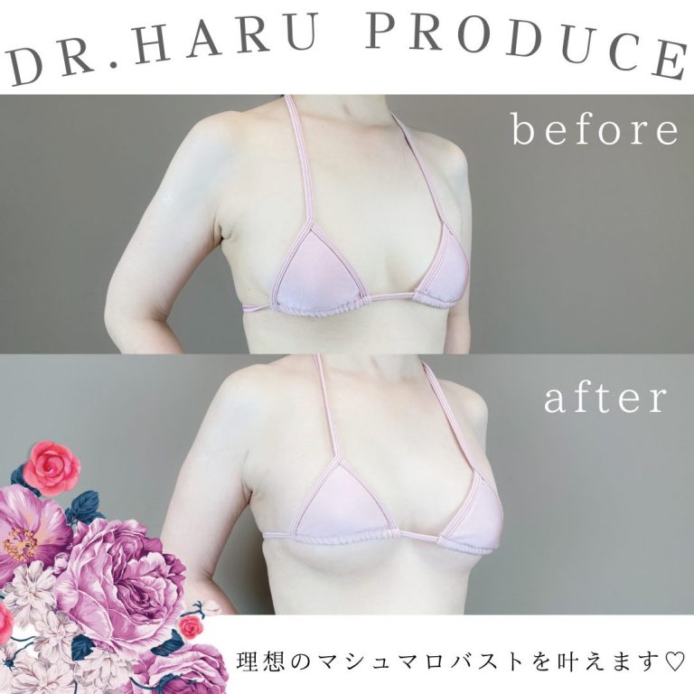 TCB式ヒアルロン酸豊胸(担当医:池田 悠 医師)の症例写真2