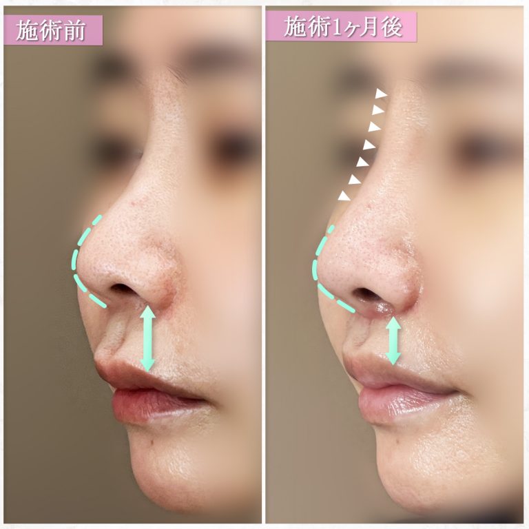 鼻プロテーゼ（隆鼻術）(担当医:篠永 宏行 医師)の症例写真3