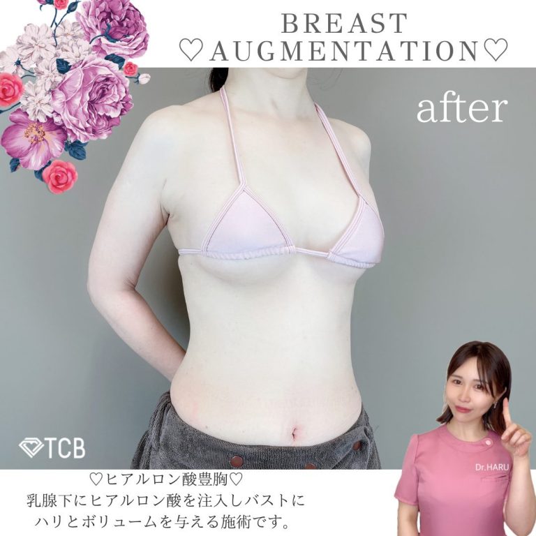 TCB式ヒアルロン酸豊胸(担当医:池田 悠 医師)の症例写真1