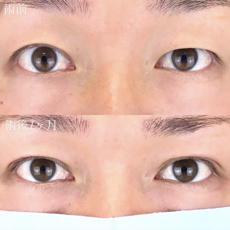 二重埋没法(担当医:TCB 医師)の症例写真1