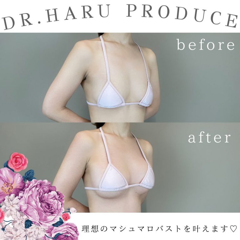 TCB式ヒアルロン酸豊胸(担当医:池田 悠 医師)の症例写真2
