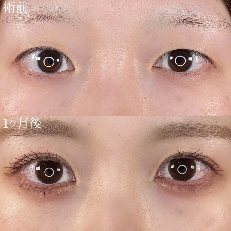 二重埋没法(担当医:TCB 医師)の症例写真2