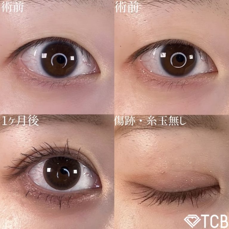 二重埋没法(担当医:TCB 医師)の症例写真1