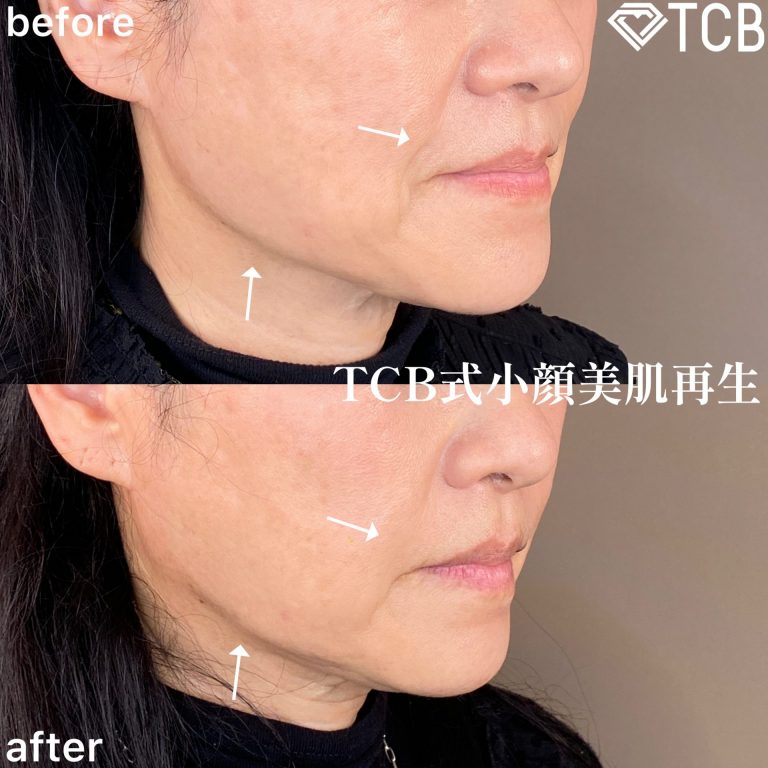 小顔美肌再生（リフトアップ）(担当医:TCB 医師)の症例写真2