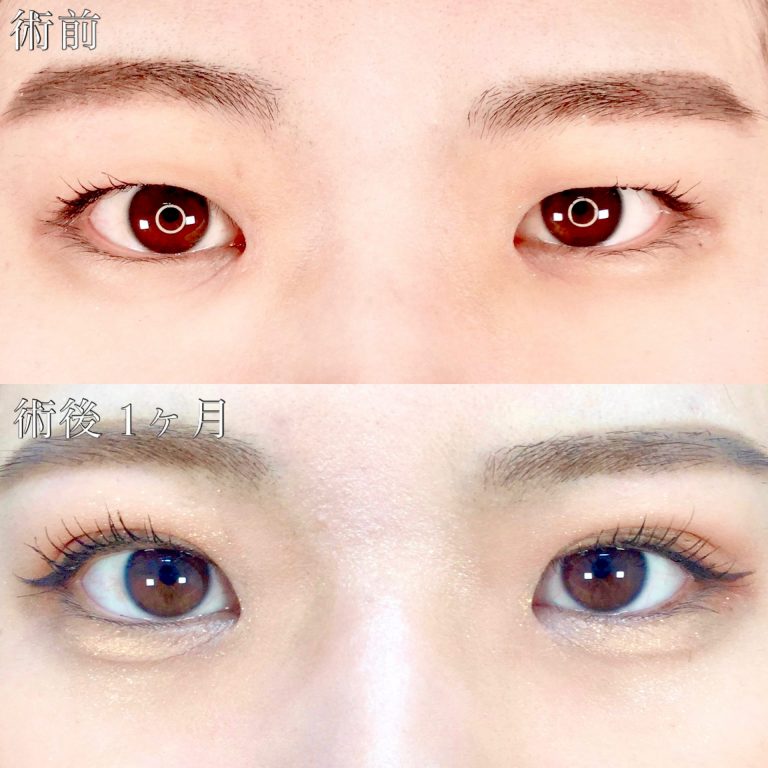二重埋没法(担当医:TCB 医師)の症例写真1