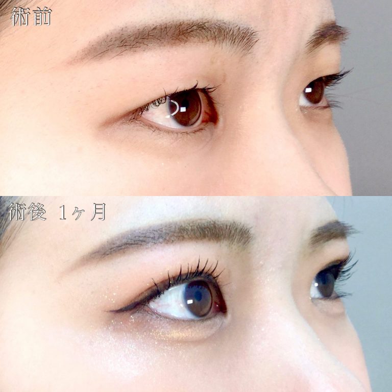 二重埋没法(担当医:TCB 医師)の症例写真2