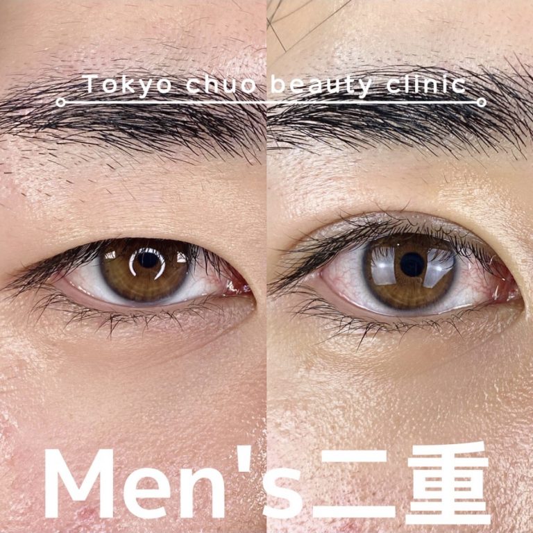 二重埋没法(担当医:TCB 医師)の症例写真1