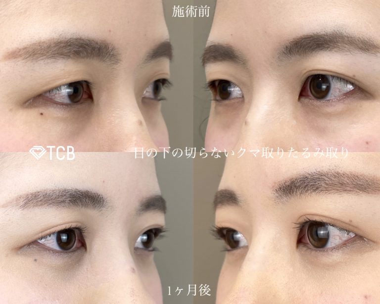 皮膚を切らない目の下のクマ取り・たるみ（ふくらみ）取り(担当医:TCB 医師)の症例写真1