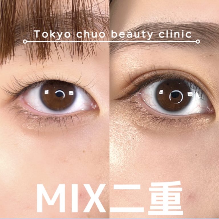 二重埋没法(担当医:TCB 医師)の症例写真1