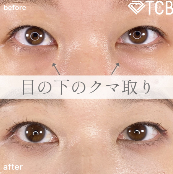 切らない目の下のクマ取り・目の下のたるみ（ふくらみ）取り(担当医:TCB 医師)の症例写真1