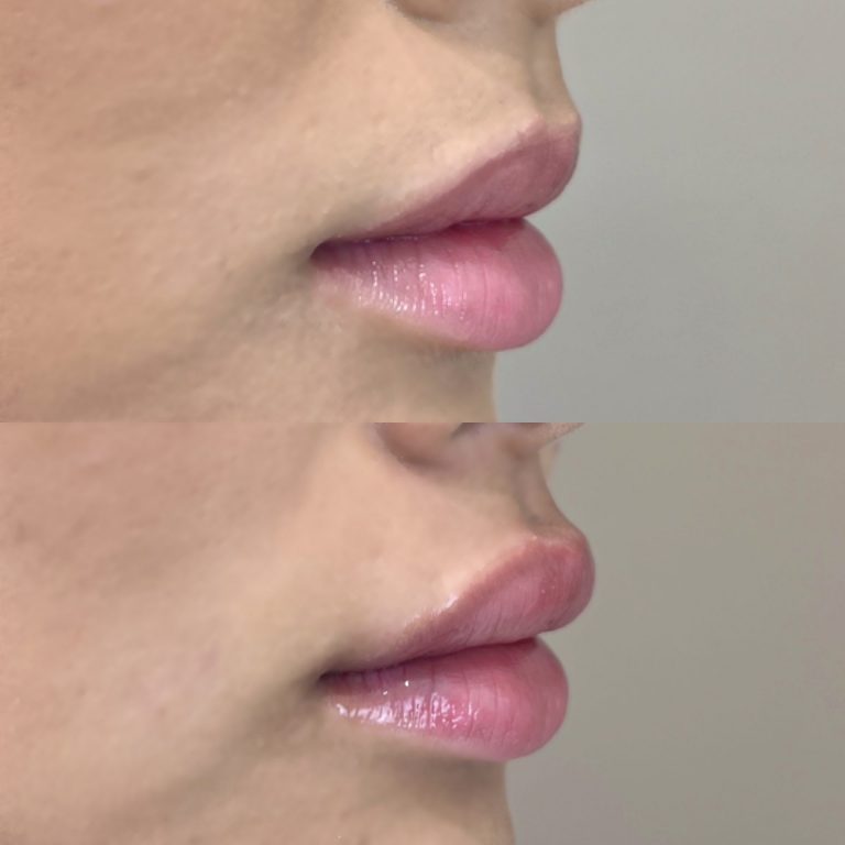 唇のヒアルロン酸注射(担当医:寺西 宏王 医師)の症例写真2