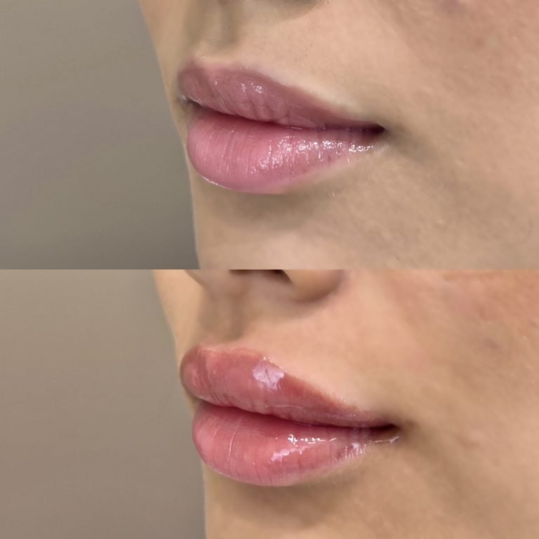 唇のヒアルロン酸注射(担当医:寺西 宏王 医師)の症例写真3
