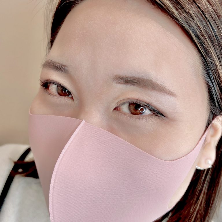 二重埋没法(担当医:TCB 医師)の症例写真2