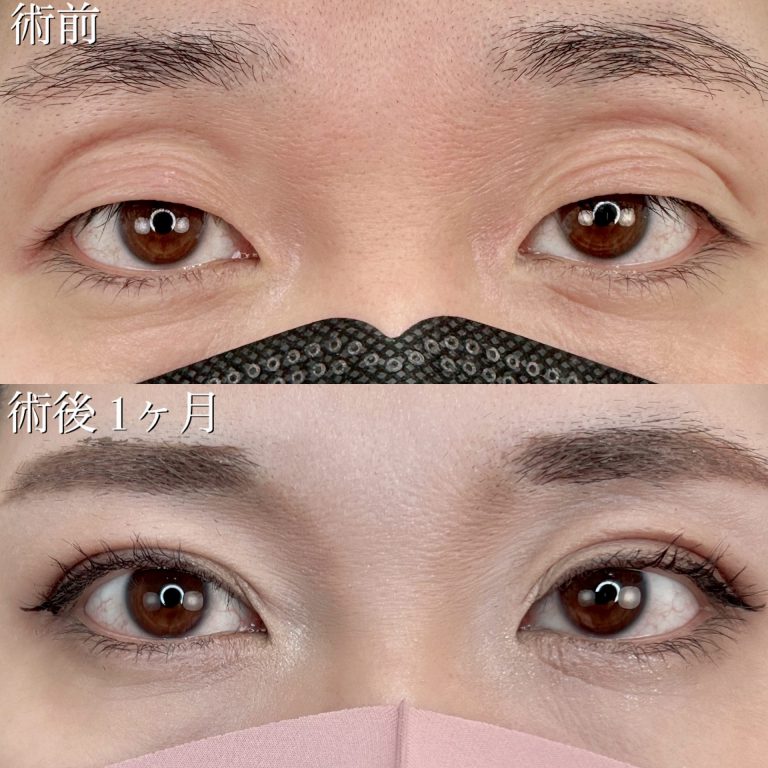 二重埋没法(担当医:TCB 医師)の症例写真1