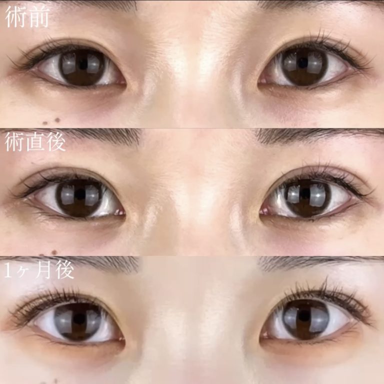 二重埋没法(担当医:TCB 医師)の症例写真1