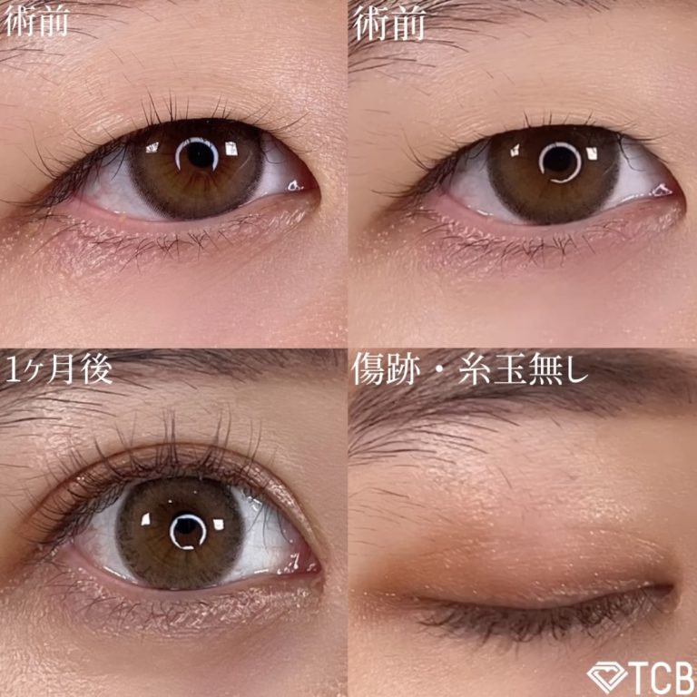 二重埋没法(担当医:TCB 医師)の症例写真1