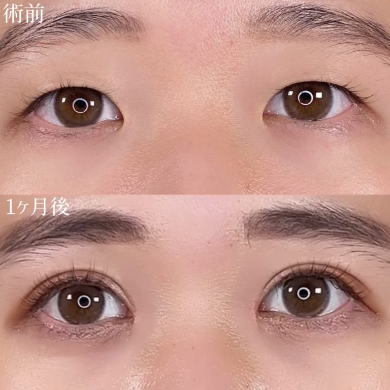 二重埋没法(担当医:TCB 医師)の症例写真2