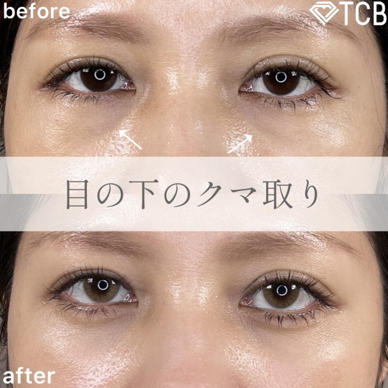 切らない目の下のクマ取り・目の下のたるみ（ふくらみ）取り(担当医:TCB 医師)の症例写真1