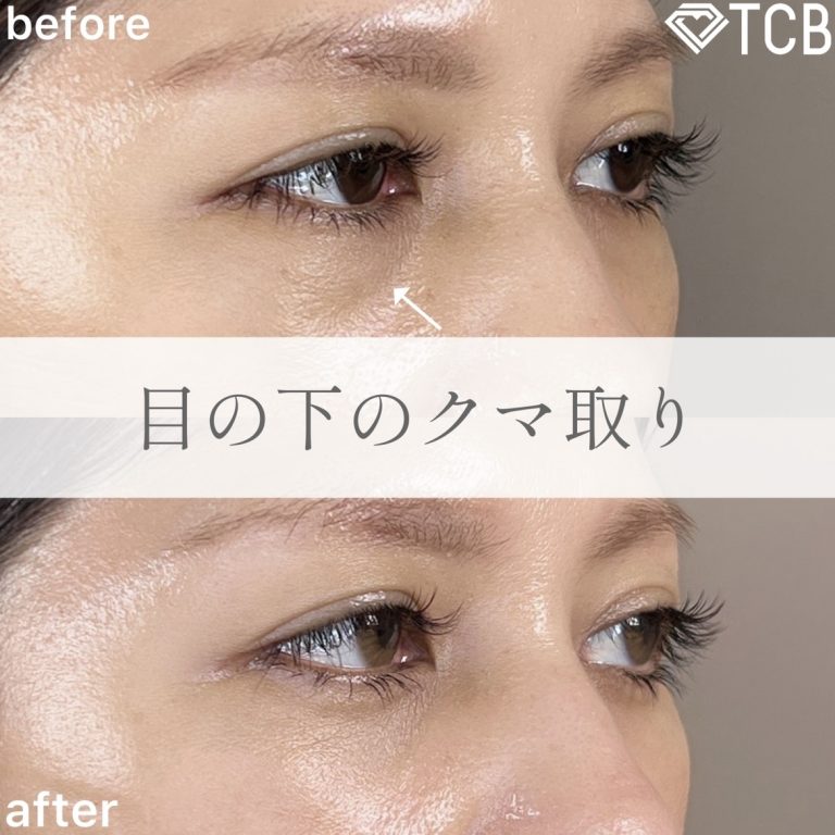 切らない目の下のクマ取り・目の下のたるみ（ふくらみ）取り(担当医:TCB 医師)の症例写真2