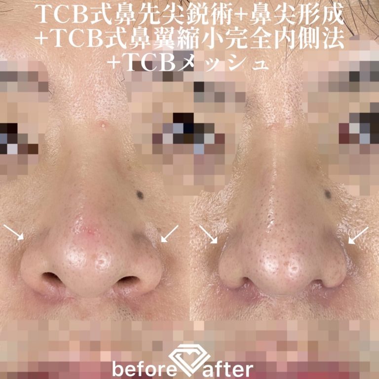 TCB式鼻先尖鋭術（だんご鼻解消）(担当医:TCB 医師)の症例写真1